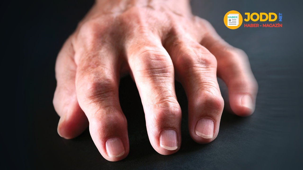Romatoid artrit olan bir kişinin el parmakları böyle görünüyor