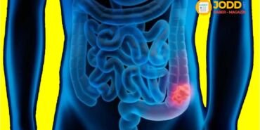 Bağırsak kanseri belirtileri nelerdir?