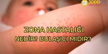 Bebeklerde zona hastalığı nedir?