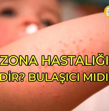 Bebeklerde zona hastalığı nedir?