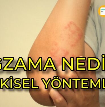 egzama nedir