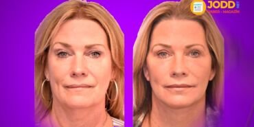 Estetik yüz gençleştirme ameliyatı