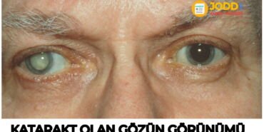 katarakt nedir? katarakt olan bir göz nasıl görünür?