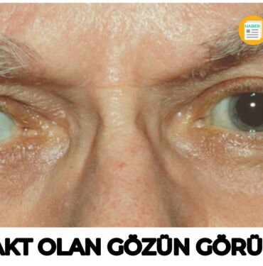 katarakt nedir? katarakt olan bir göz nasıl görünür?