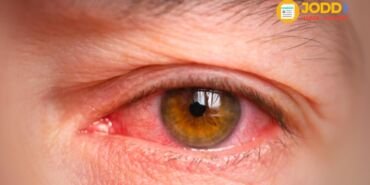 konjonktivit nedir ne iyi gelir