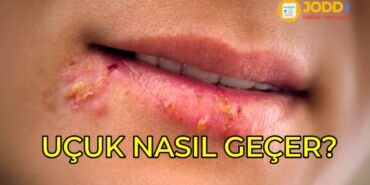 Uçuk nedir? Uçuk nasıl geçer?