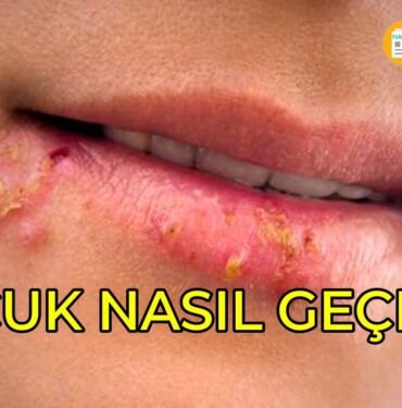 Uçuk nedir? Uçuk nasıl geçer?