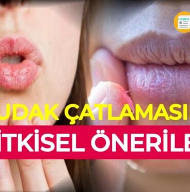 Dudak çatlaması bitkisel öneriler