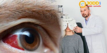 Göz kanaması nasıl geçer